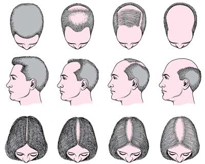 Hair Loss in Men and Women. There's some emerging research that points to 