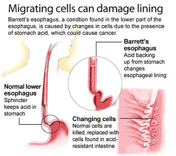 Symptoms Of Esophagus Problems |.